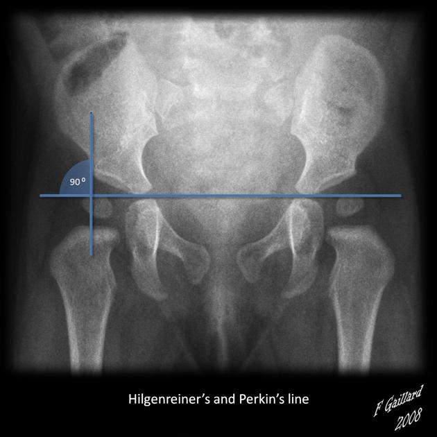 acetabular angle